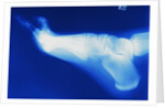 X-Ray of Person's Foot by Anonymous