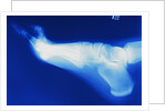 X-Ray of Person's Foot by Anonymous