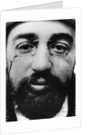 Face of French Artist Henri de Toulouse-Lautrec by Anonymous