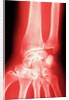 X-ray of a Wrist by Anonymous
