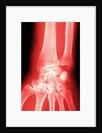 X-ray of a Wrist by Anonymous