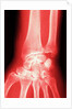 X-ray of a Wrist by Anonymous