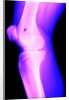 X-Ray of a Knee by Anonymous