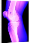 X-Ray of a Knee by Anonymous