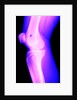 X-Ray of a Knee by Anonymous