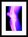 X-Ray of a Knee by Anonymous
