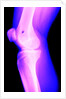 X-Ray of a Knee by Anonymous