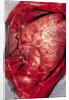 Donor's Heart in Thomas' Chest by Anonymous