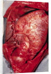 Donor's Heart in Thomas' Chest by Anonymous
