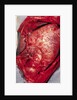 Donor's Heart in Thomas' Chest by Anonymous