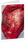 Donor's Heart in Thomas' Chest by Anonymous