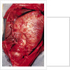 Donor's Heart in Thomas' Chest by Anonymous