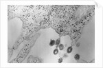 Tumors Budding from Cell Membrane by Anonymous