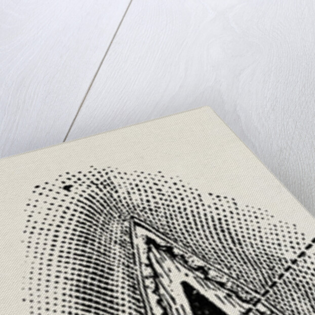 Ligatuite of the right radial by Anonymous