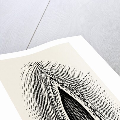 Ligatuite of the right radial by Anonymous