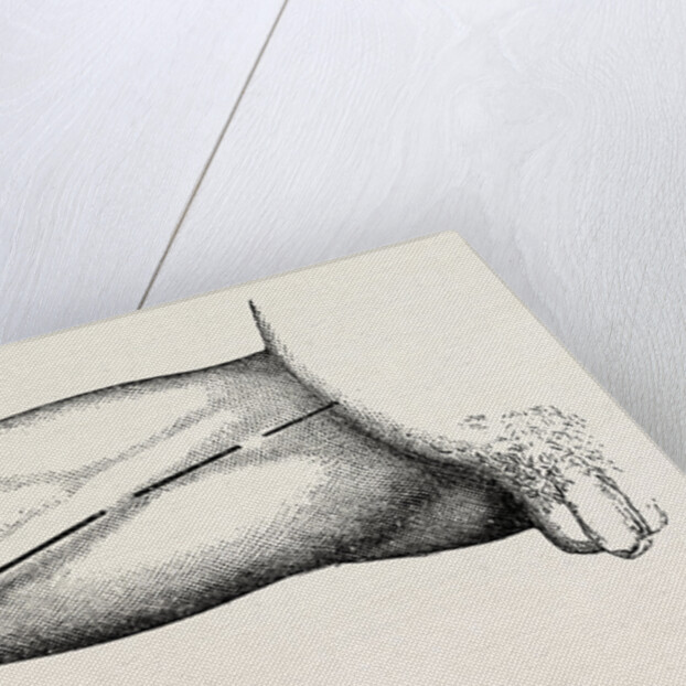 Ligature of the right common femoral at the base of scarpa's by Anonymous