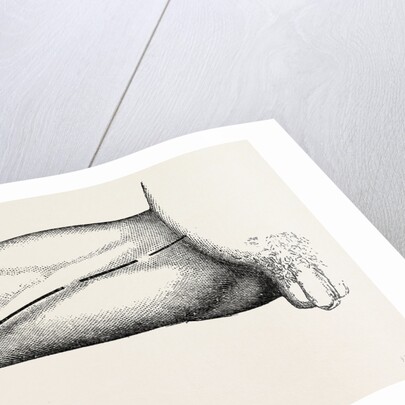 Ligature of the right common femoral at the base of scarpa's by Anonymous