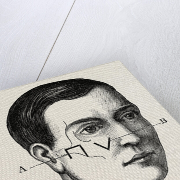 A neurotomy of third division by Anonymous