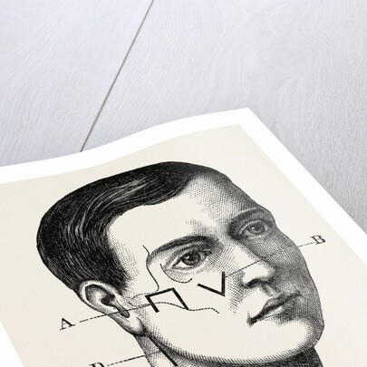 A neurotomy of third division by Anonymous