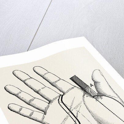 Disartieulation of the thumb by Anonymous