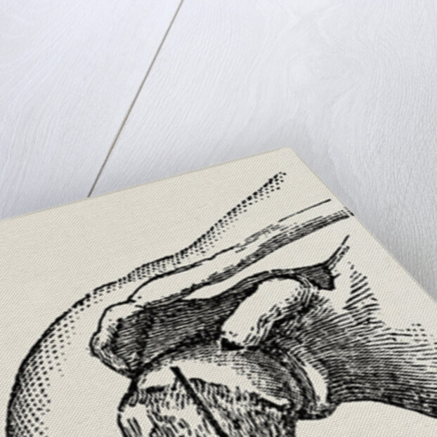 Disarticulation by Anonymous