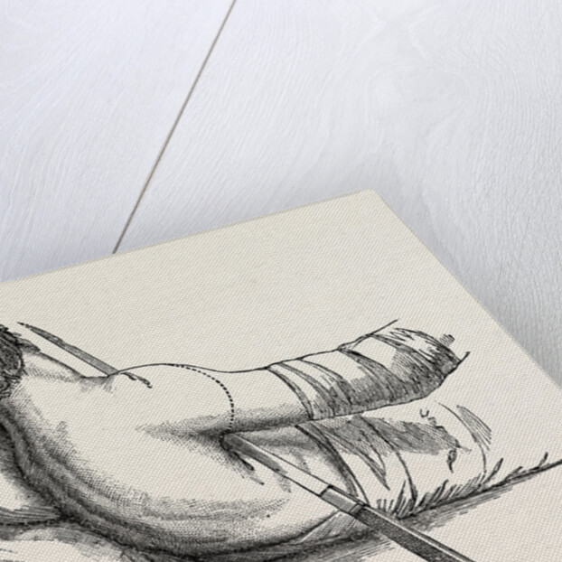 Amputation at the shoulder-joint by transfixion by Anonymous