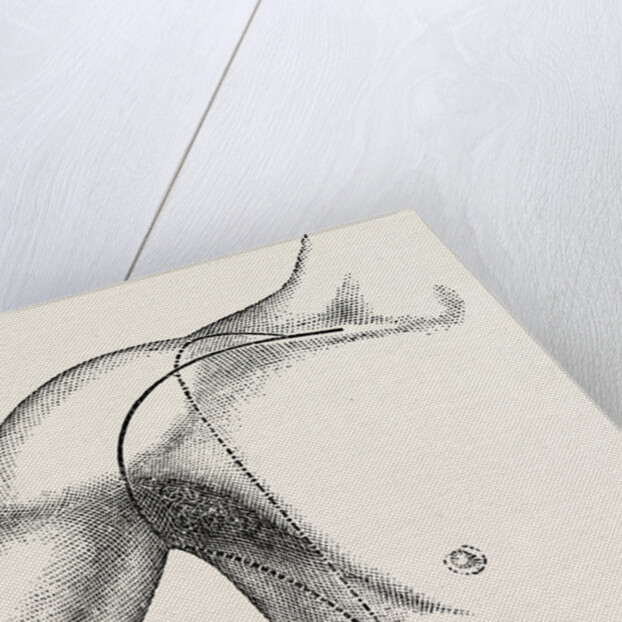 Interscapulo-tholtacic amputation by Anonymous