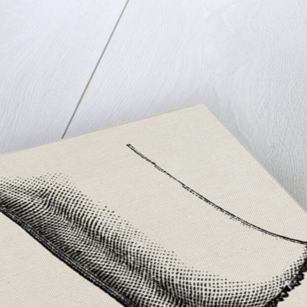 Syme's amputation by Anonymous