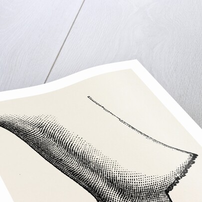 Syme's amputation by Anonymous