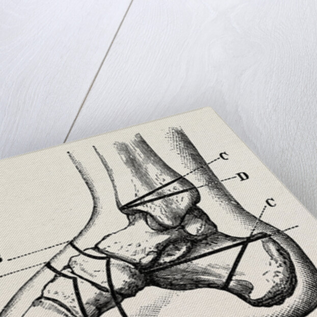 Farabeuf's subastragaloid amputation by Anonymous