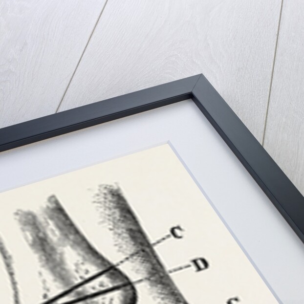 Farabeuf's subastragaloid amputation by Anonymous