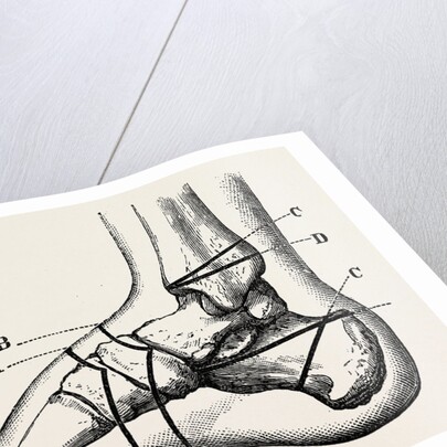 Farabeuf's subastragaloid amputation by Anonymous