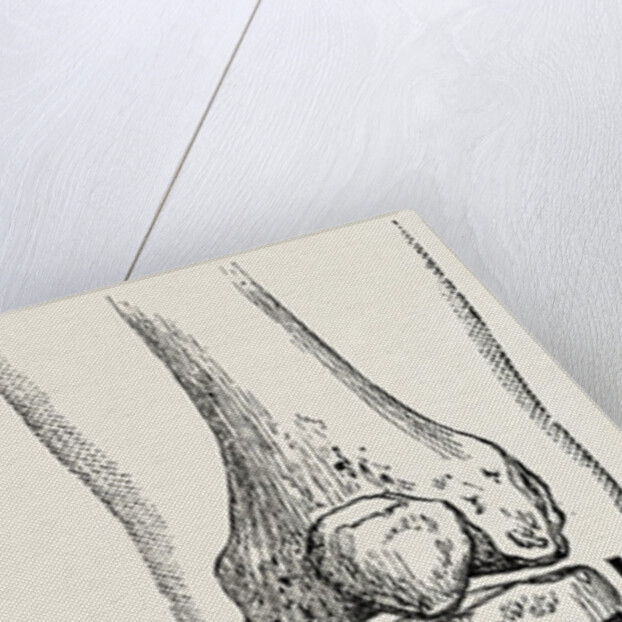 Amputation by Anonymous