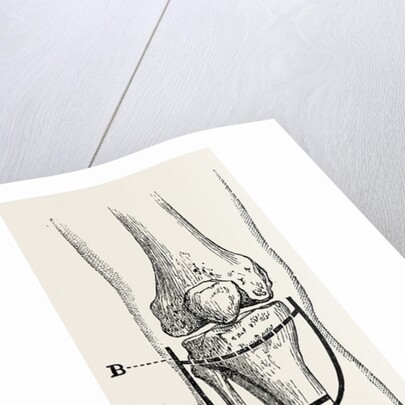 Amputation by Anonymous