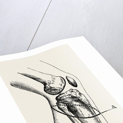 Disarticulation isarticulation by Anonymous