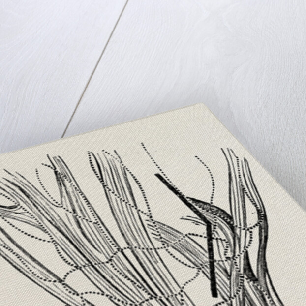 Excision of the wrist by Anonymous