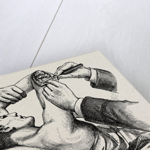 Excision of the elbow, the clearing of the humerus by Anonymous