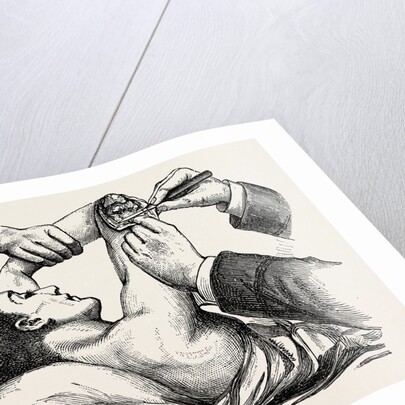 Excision of the elbow, the clearing of the humerus by Anonymous
