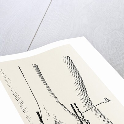 Excision by Anonymous