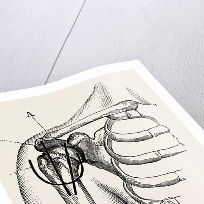 Excision of the shoulder by Anonymous