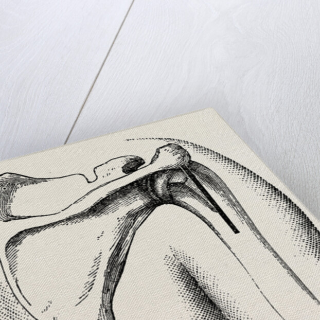 Excision of shoulder by Anonymous
