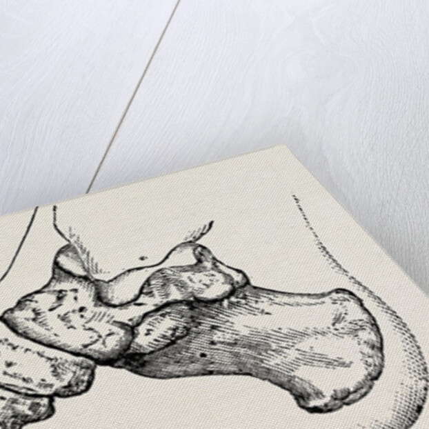 Eicision of first metatarsal bone, flap by Anonymous