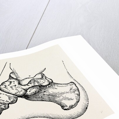 Eicision of first metatarsal bone, flap by Anonymous