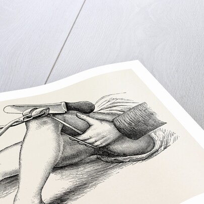 Excision of the knee, the sawing of the lower end by Anonymous