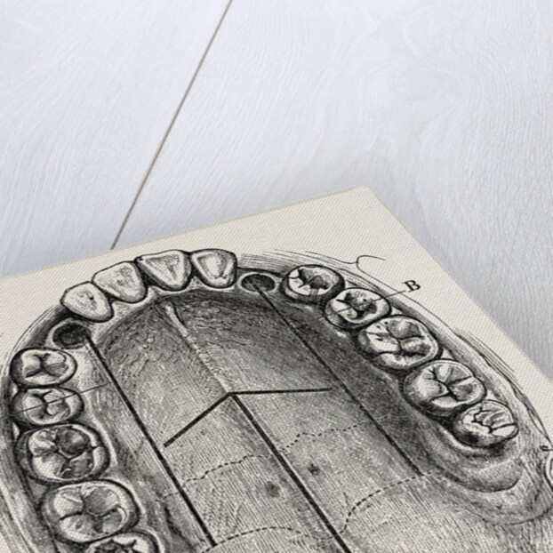 Nelaton's operation for nasal polypus by Anonymous