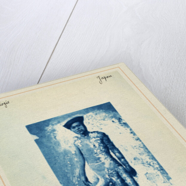 Elephantiasis, c. 1870s by Anonymous