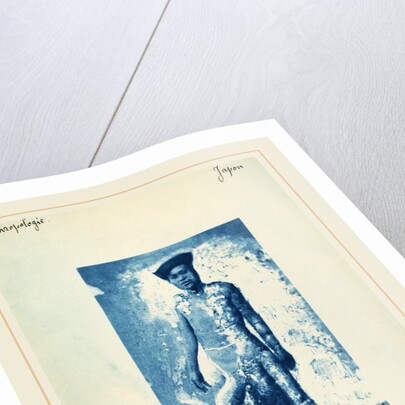 Elephantiasis, c. 1870s by Anonymous