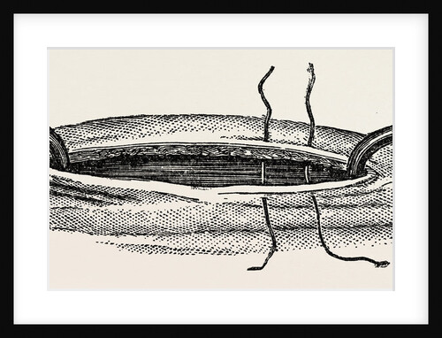 Method of steadying the margins of a wound with blunt hooks by Anonymous