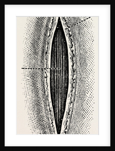Ligatuite of the right radial by Anonymous