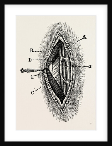 Ligatuite of the right radial by Anonymous